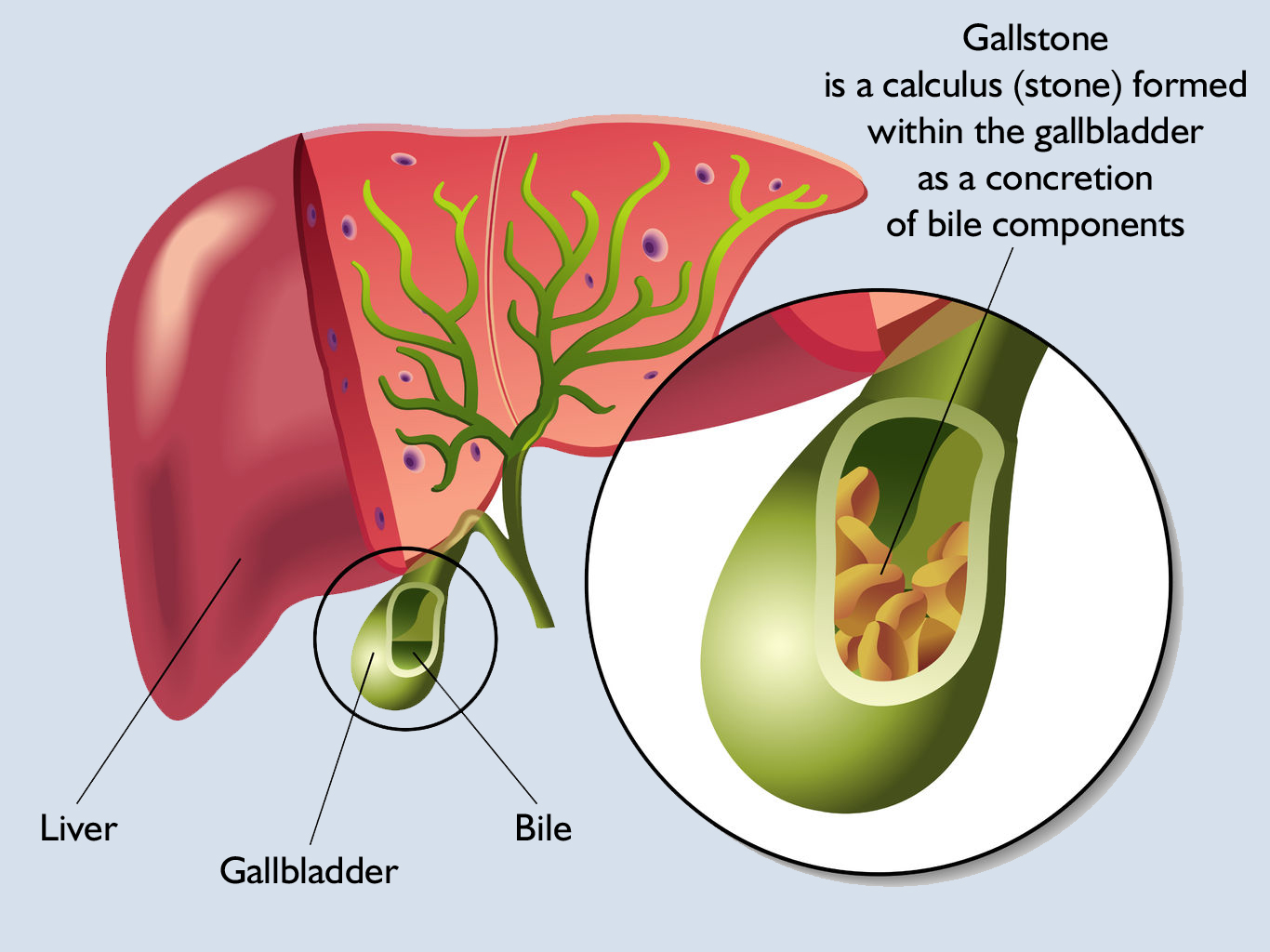 gallstones-crohn-s-disease-inflammatoryboweldisease