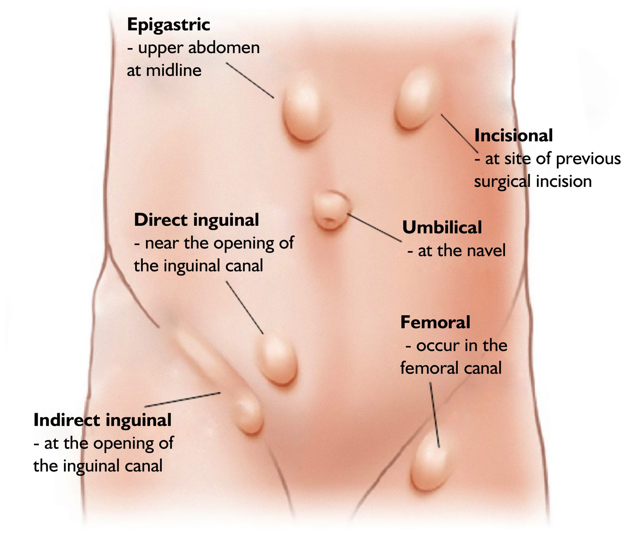 Types And Treatments Of Hernia Mysurgeryabroad Medicover Hospital