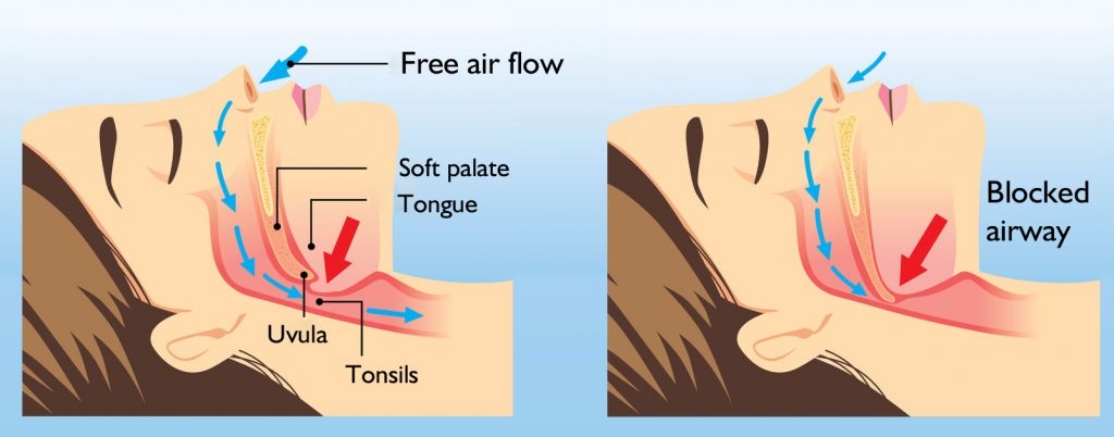 Snoring and sleep apnea treatment - Mysurgeryabroad - Medicare Hospital ...