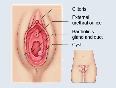 Removal of Bartholin gland cyst from vagina : r/MedicalGore