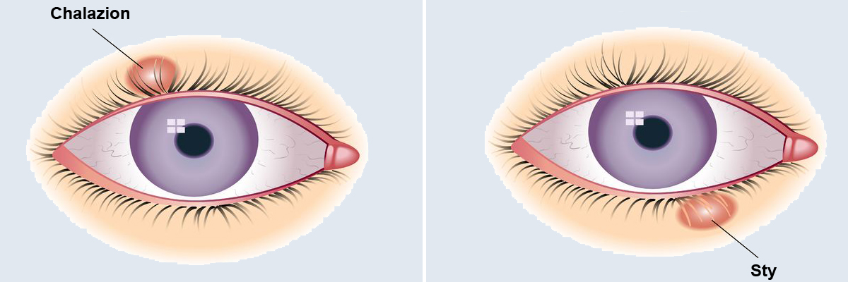 Chalazion and sty