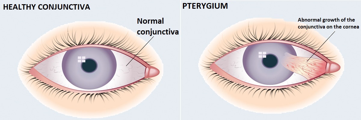 conjuctiva